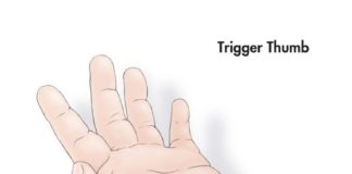 Trigger finger