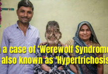 In a case of ‘Werewolf Syndrome', also known as 'Hypertrichosis