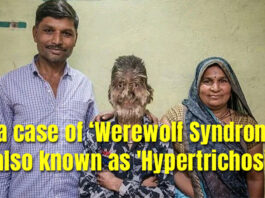 In a case of ‘Werewolf Syndrome', also known as 'Hypertrichosis