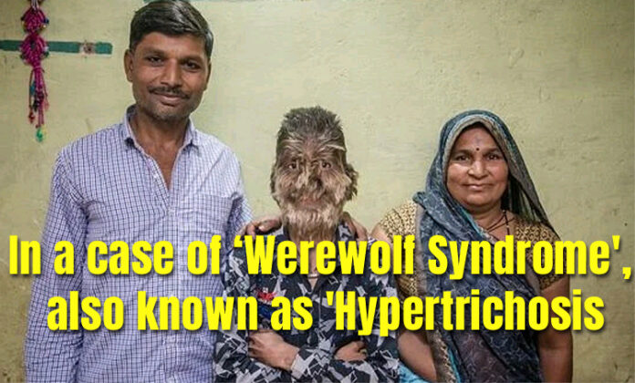 In a case of ‘Werewolf Syndrome', also known as 'Hypertrichosis